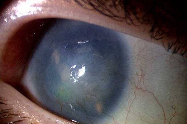 Глаукома - заболевание глаз у больных сахарным диабетом
