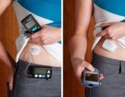 Инсулиновая помпа при диабете
