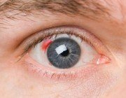 Заболевания глаз у больных сахарным диабетом